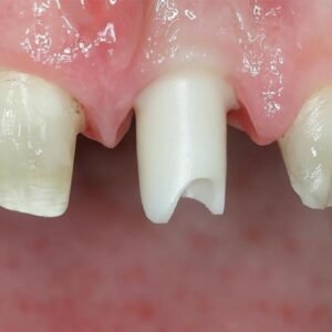 Anterior Implant Prosthetics