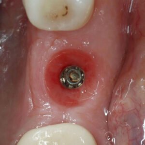 Intégrez les implants dentaires à votre pratique (The French Version)