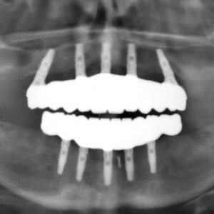 Implant Prosthetics: Full Arch Restorations