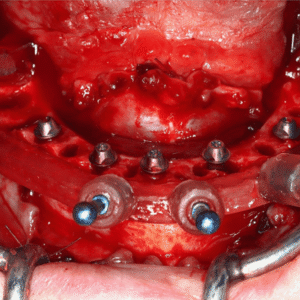 Advanced Implant Residency