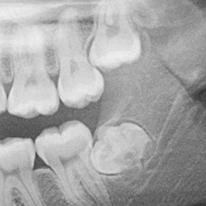 Wisdom Teeth and General Surgery